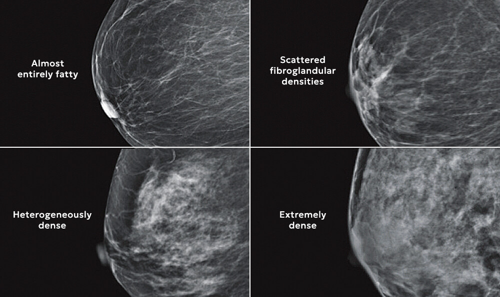 Breast Density Chart